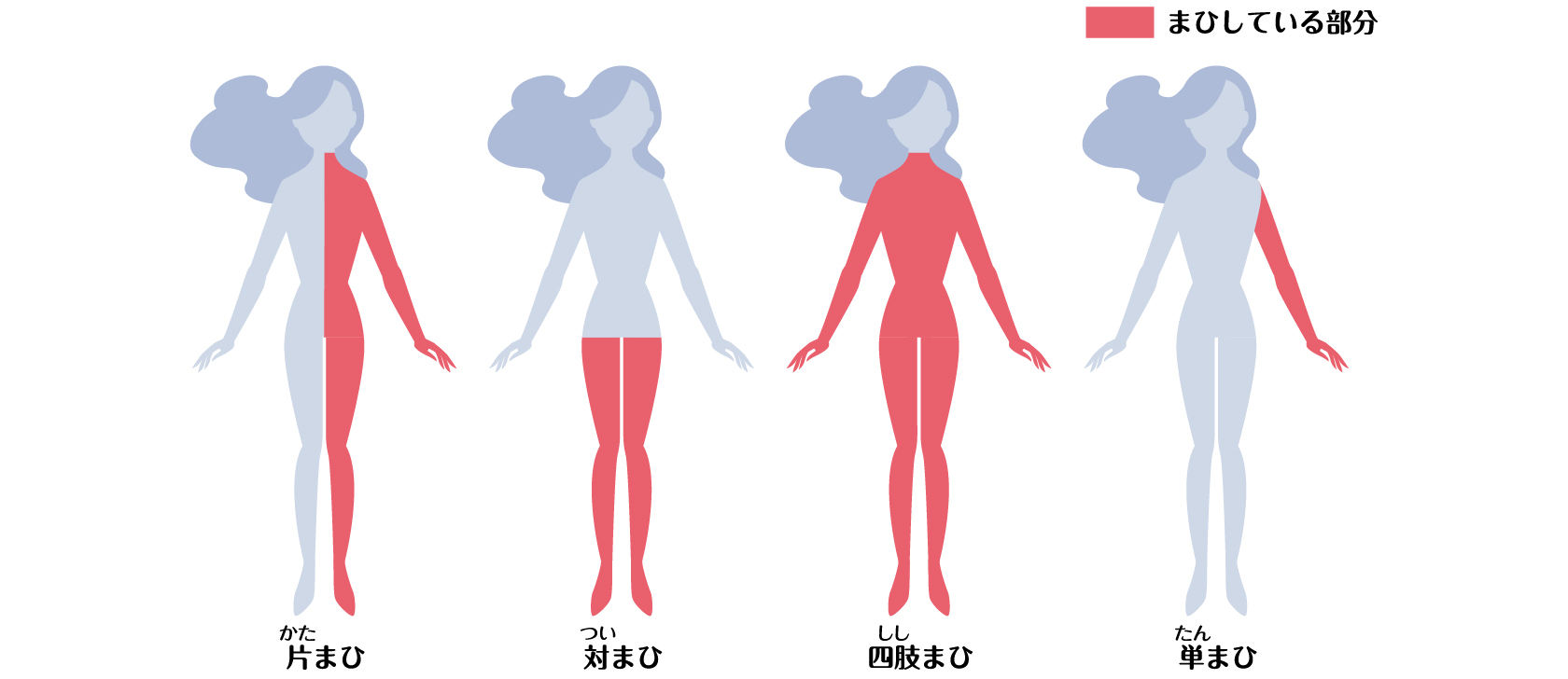 片まひ、対まひ、四肢まひ、単まひの発症部位のイメージ図。