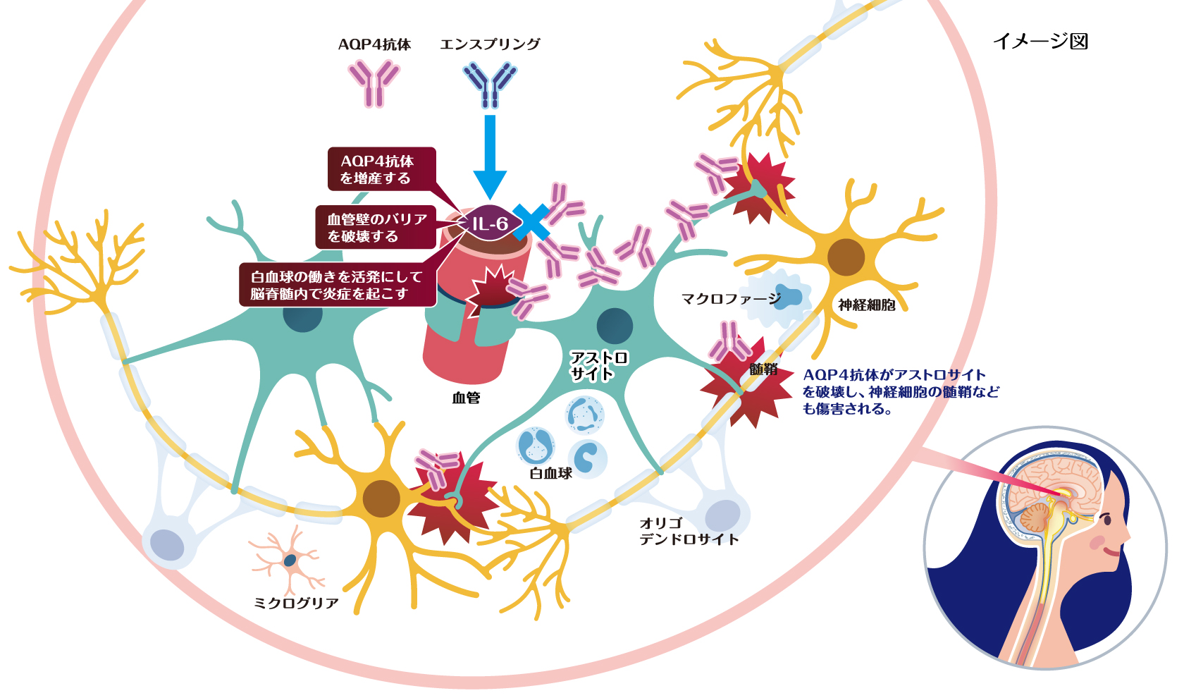 NMOSD病態へのIL-6の影響とエンスプリングの作用をイメージした図。AQP4抗体・エンスプリング、AQP4抗体を増産する、血管壁のバリアを破壊する、白血球の働きを活発にして脳脊髄内で炎症を起こす。IL-6・血管・ミクログリア・アストロサイト・白血球・オリゴデンドロサイト・マクロファージ・髄鞘・神経細胞。AQP4抗体がアストロサイトを破壊し、神経細胞の髄鞘なども傷害される。