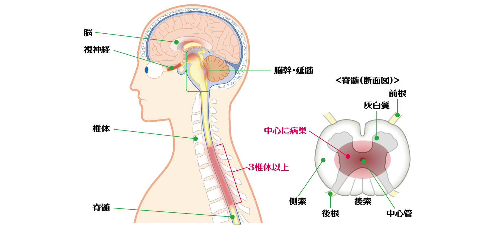 脳、視神経、脳幹・延髄、椎体、脊髄、そのうち3椎体以上の長い病変のイメージ図。脊髄断面図、前根、灰白質、側索、後根、後索、中心管、その中心に病巣があるイメージ図。